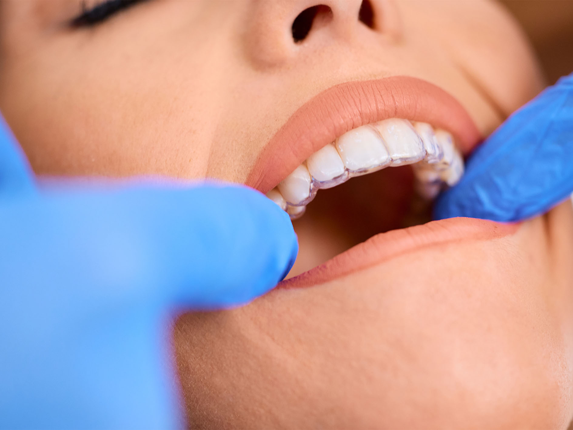 clear aligners in langley