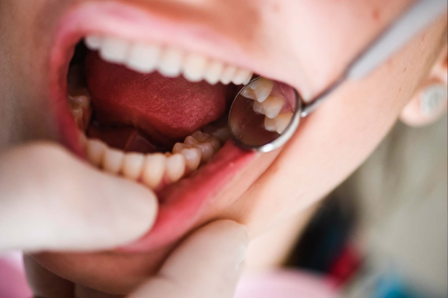 Wisdom Teeth Removal Langley