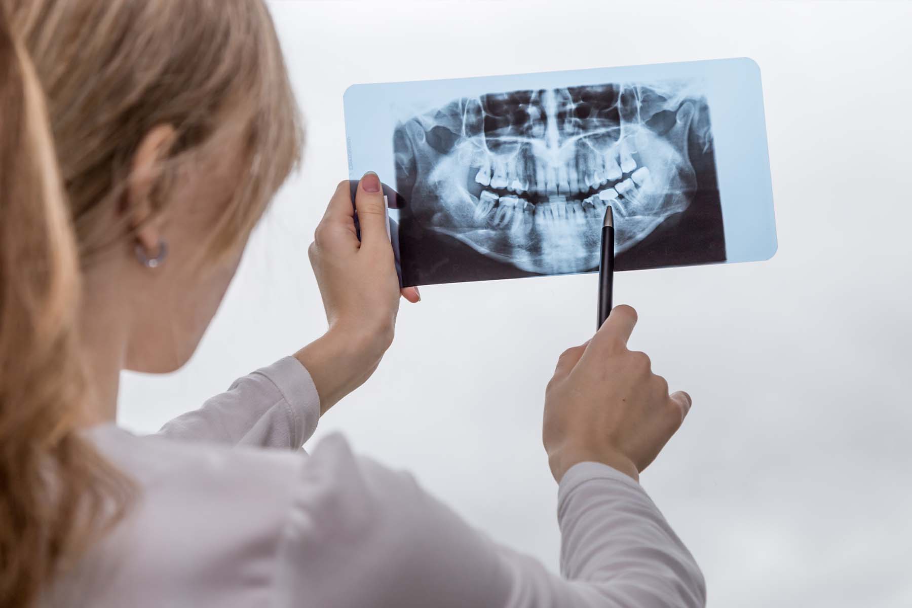 Wisdom Teeth Removal Langley