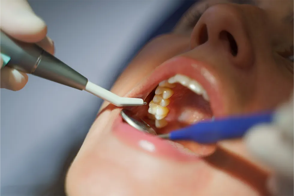 Teeth Filling vs Crown
